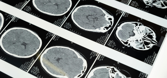 ADHD en RSD: Hoe werkt het in het brein?